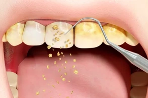 К чему снится налёт на зубах