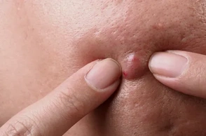 К чему снится чирей