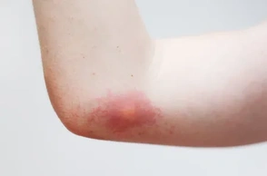 К чему снится укус осы в руку