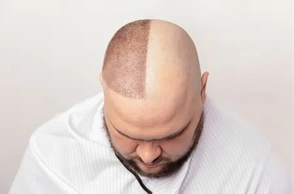 К чему снится лысина